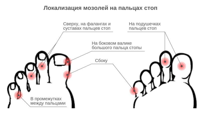 Стержневая мозоль на пальце ноги сбоку