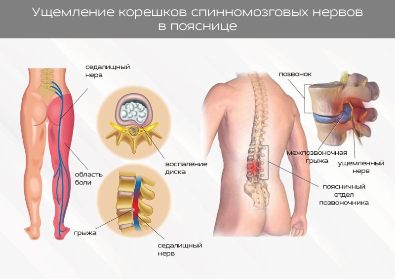 Радикулопатия l3 корешка